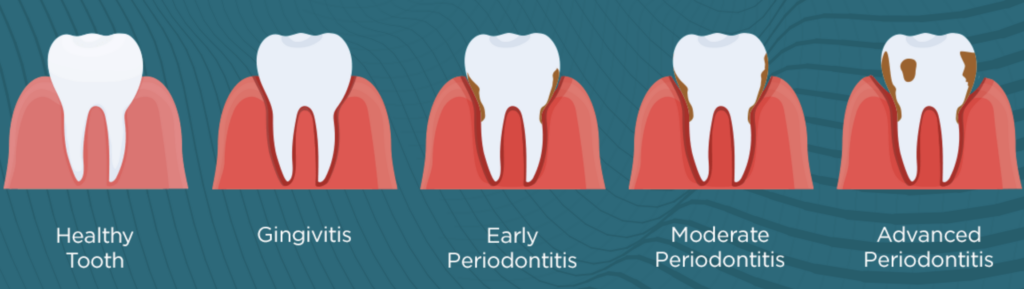 Dentist-Toa-Payoh-Gum-Disease-Stages